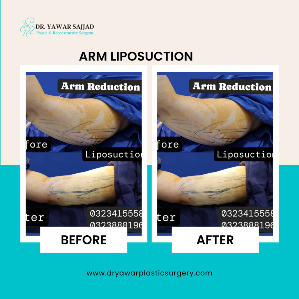 arm liposuction before and after