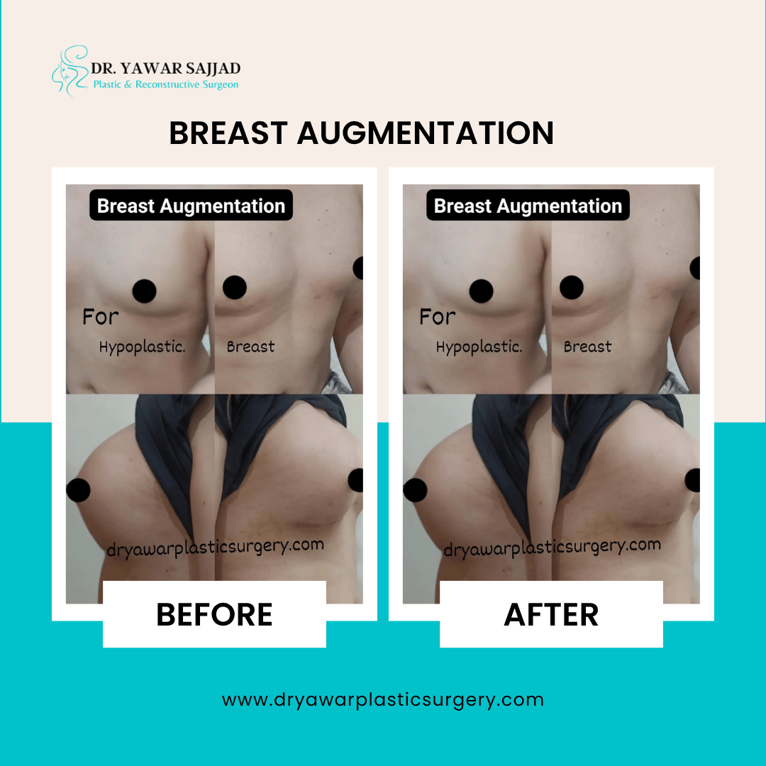 breast augmentation surgery lahore