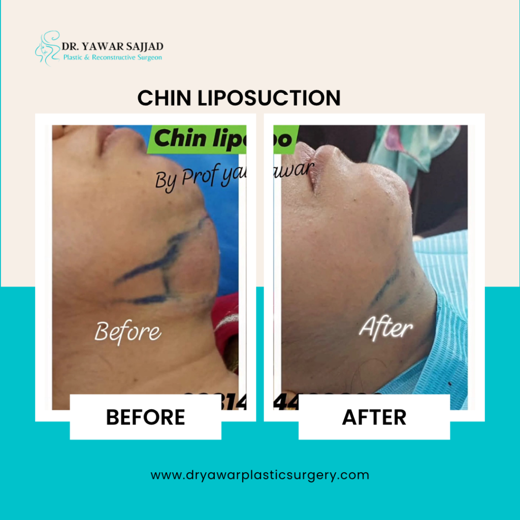 double chin liposuction lahore