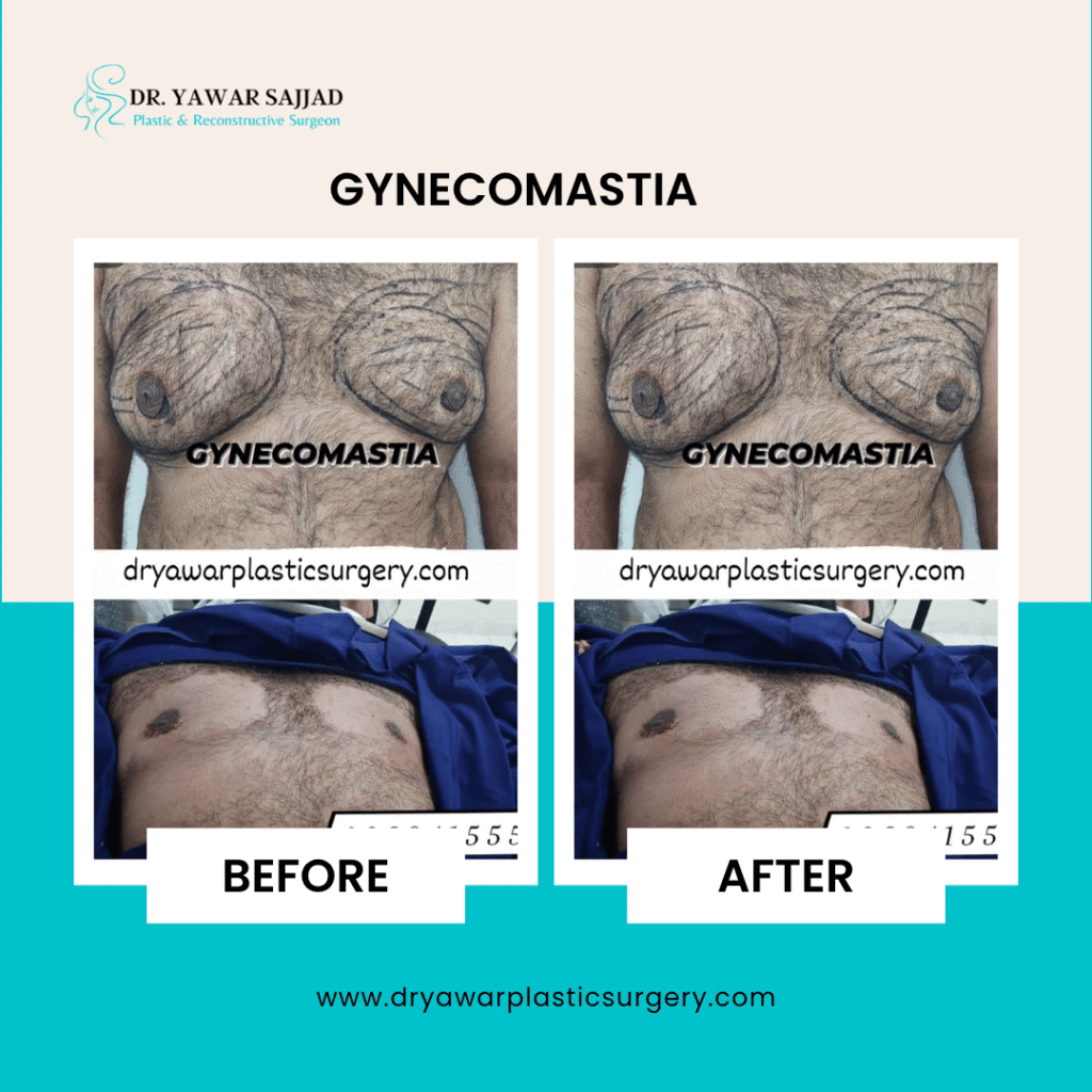 gynecomastia surgery lahore